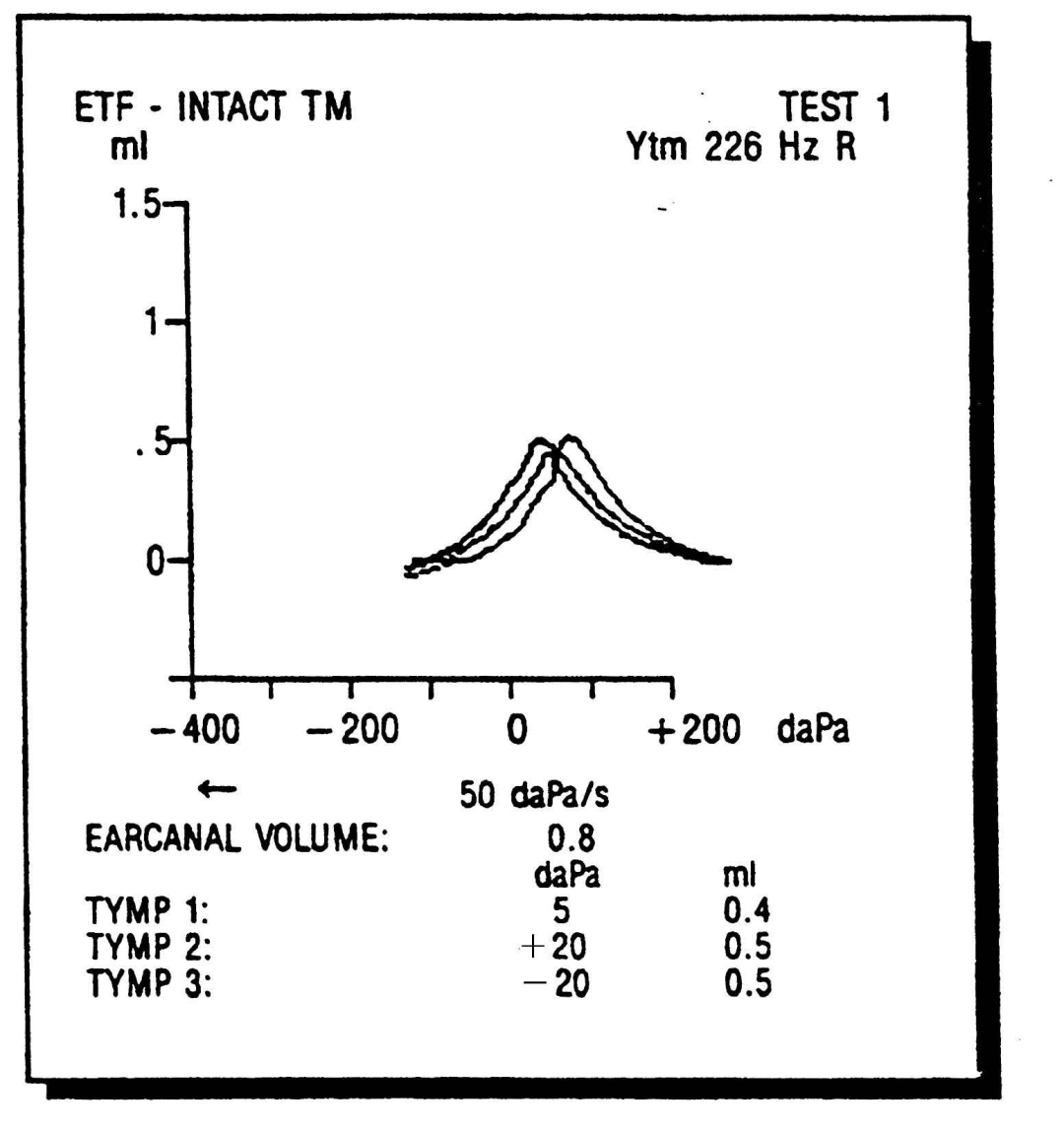 關(guān)于耳聲反射測(cè)試，你了解多少？